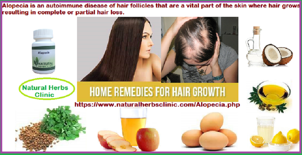 Alopecia Natural Treatment