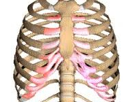 Costochondritis