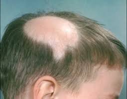 Alopecia Symptoms, Diagnosis and Treatment with Natural Remedies