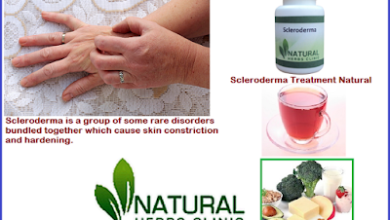 C Scleroderma Treatment Natural Scleroderma Alternative Treatments Natural Treatment for Scleroderma - Natural Herbs Clinic