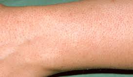 Keratosis Pilaris