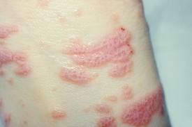 Lichen Planus 1