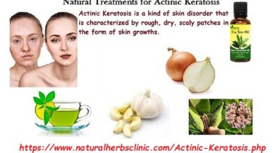 Natural-Treatment-for-Actinic-Keratosis 1