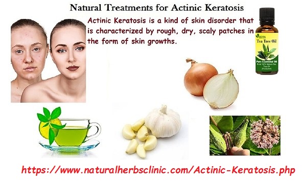 Natural Remedies for Actinic Keratosis Natural Remedies for Actinic Keratosis
