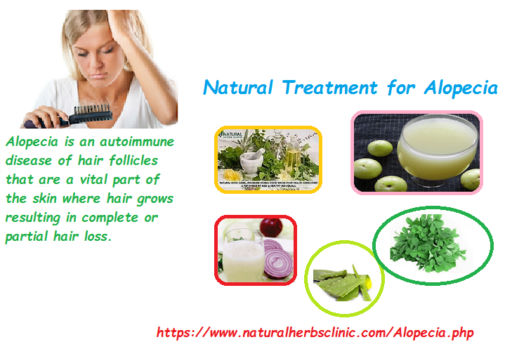 Natural Treatment for Alopecia