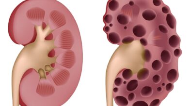 Polycystic Kidney Disease - A Serious Disease Of Kidneys