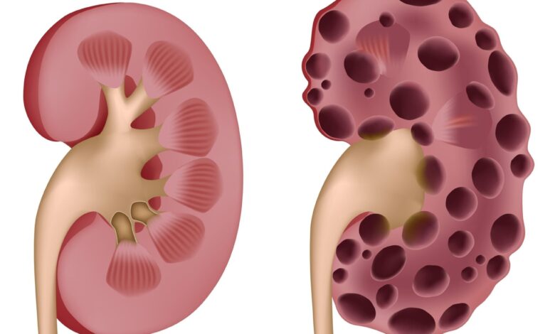 Polycystic Kidney Disease - A Serious Disease Of Kidneys