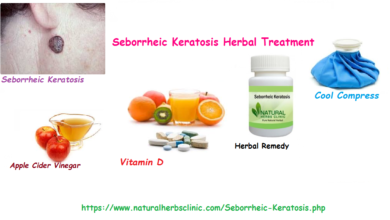 Seborrheic Keratosis – A Fairly Common Skin Lesion