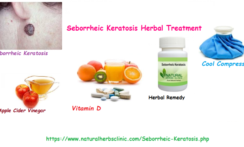 Seborrheic Keratosis – A Fairly Common Skin Lesion