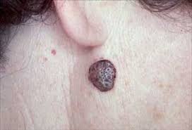 Seborrheic Keratosis