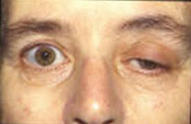 Myasthenia Gravis