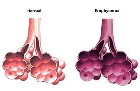 Emphysema