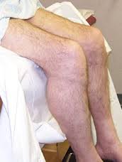 Inclusion Body Myositis