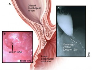 Achalasia