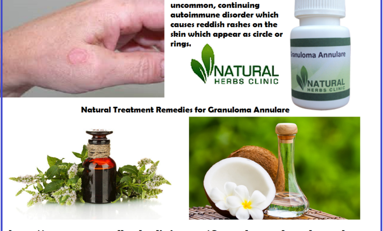 Granuloma-Annulare-in-Adults-Granuloma-Annulare-Natural-Treatment-Natural-Treatment-for-Granuloma-Annulare