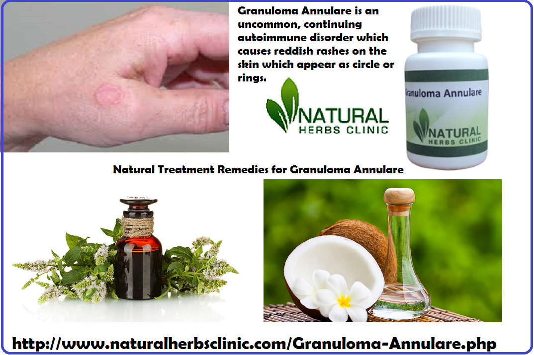 Granuloma Annulare Herbal Treatment