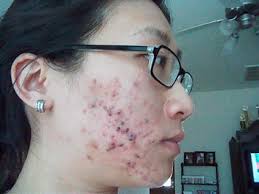 How Do Individuals Get Hidradenitis Suppurativa