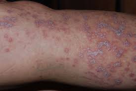 Lichen-planus-treatment