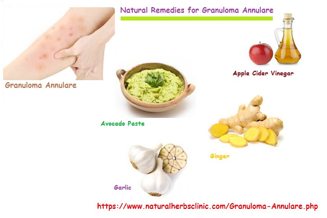 Natural Remedies for Granuloma Annulare