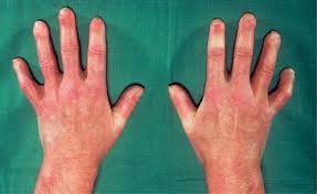 Scleroderma