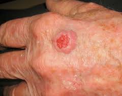 Actinic Keratosis