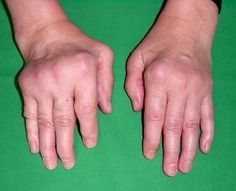 Inclusion Body Myositis