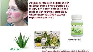 Natural-Treatment-for-Actinic-Keratosis