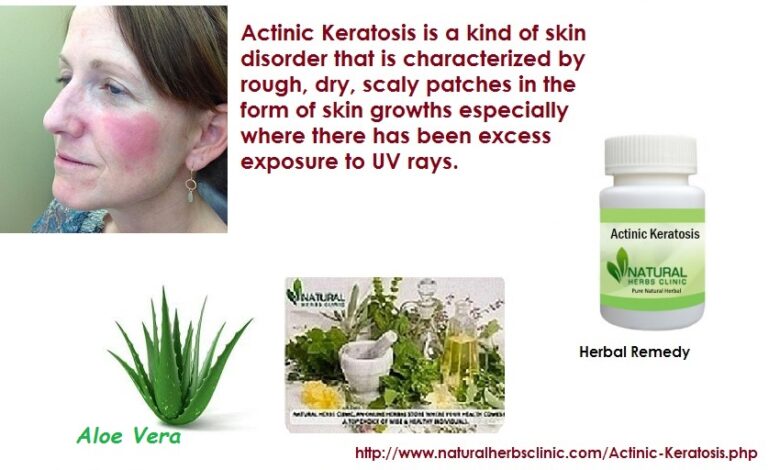Natural-Treatment-for-Actinic-Keratosis