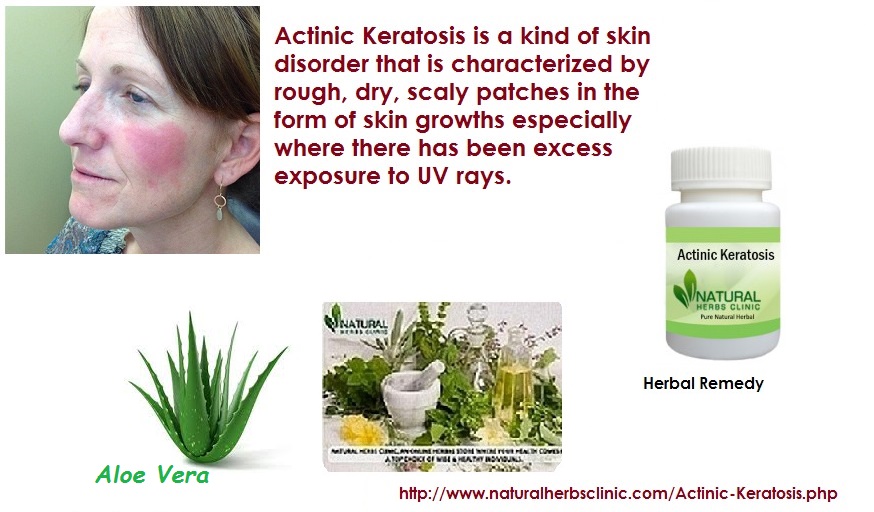 Natural Remedies for Actinic keratosis