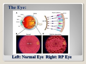 Retinitis Pigmentosa