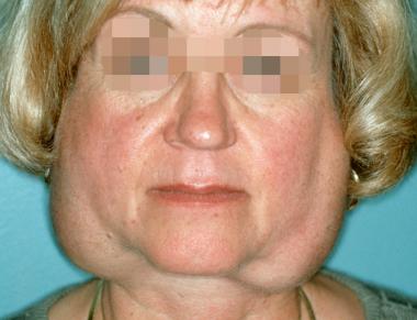 What is sjogren's autoimmune disease