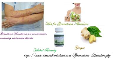 Natural-Treatment-for-Granuloma-Annulare