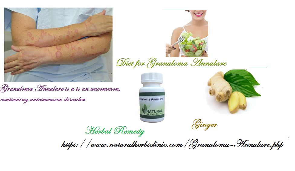 Granuloma Annulare Herbal Treatment