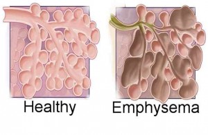 Emphysema Herbal Treatment