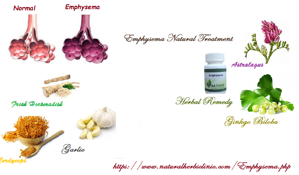 Emphysema Herbal Treatment