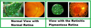 Retinitis Pigmentosa Causes, Symptoms and Treatment with Herbal Remedies