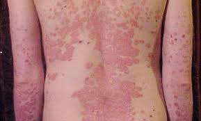 5-Home-Remedies-for-Lichen-Planus