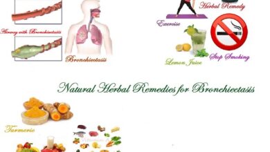 Bronchiectasis-Herbal-Treatment