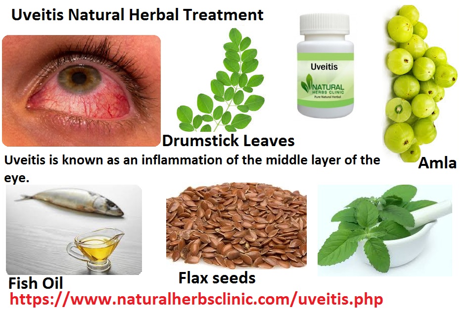 Herbal Remedies for Uveitis Symptoms, Causes, Treatment Natural