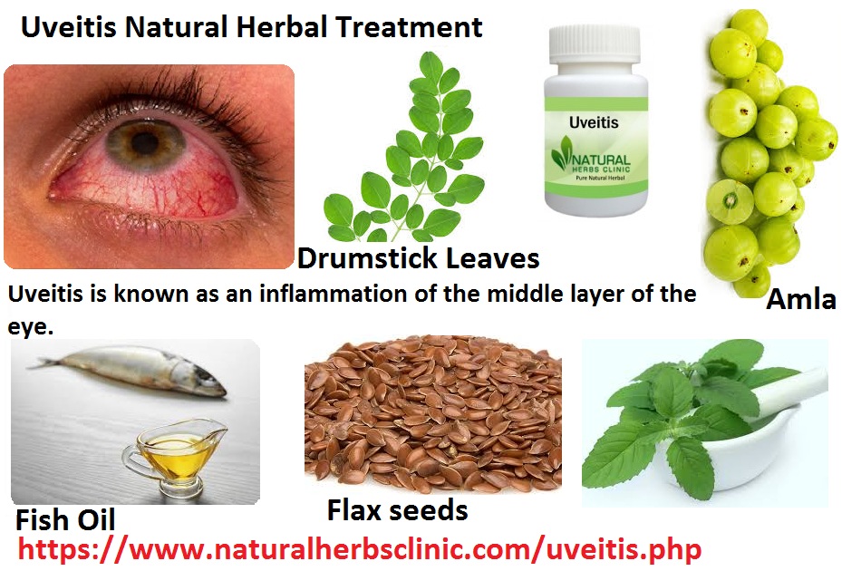 Uveitis Natural Herbal Treatment