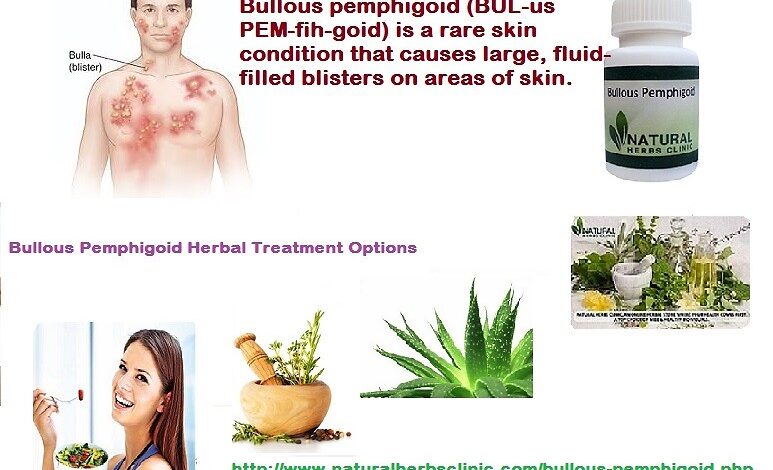 Pemphigoid-Natural-Herbal-Treatment