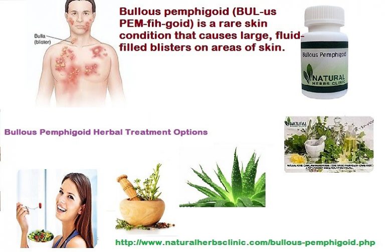 Bullous Pemphigoid Treatment Archives - Natural Herbs Clinic - Blog