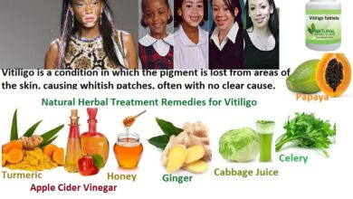 8-Natural-Herbal-Treatment-Remedies-for-Vitiligo-1