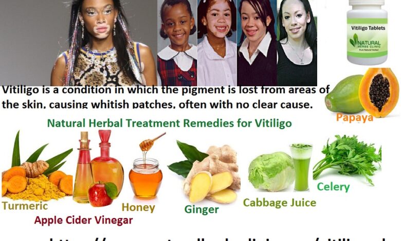 8-Natural-Herbal-Treatment-Remedies-for-Vitiligo-1