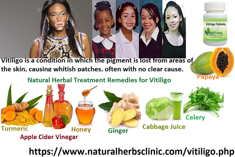 Vitiligo Natural Herbal Treatment