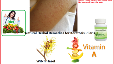 Keratosis-Pilaris-Natural-Herbal-Treatment