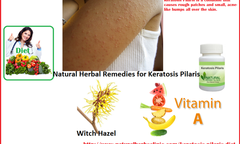Keratosis-Pilaris-Natural-Herbal-Treatment