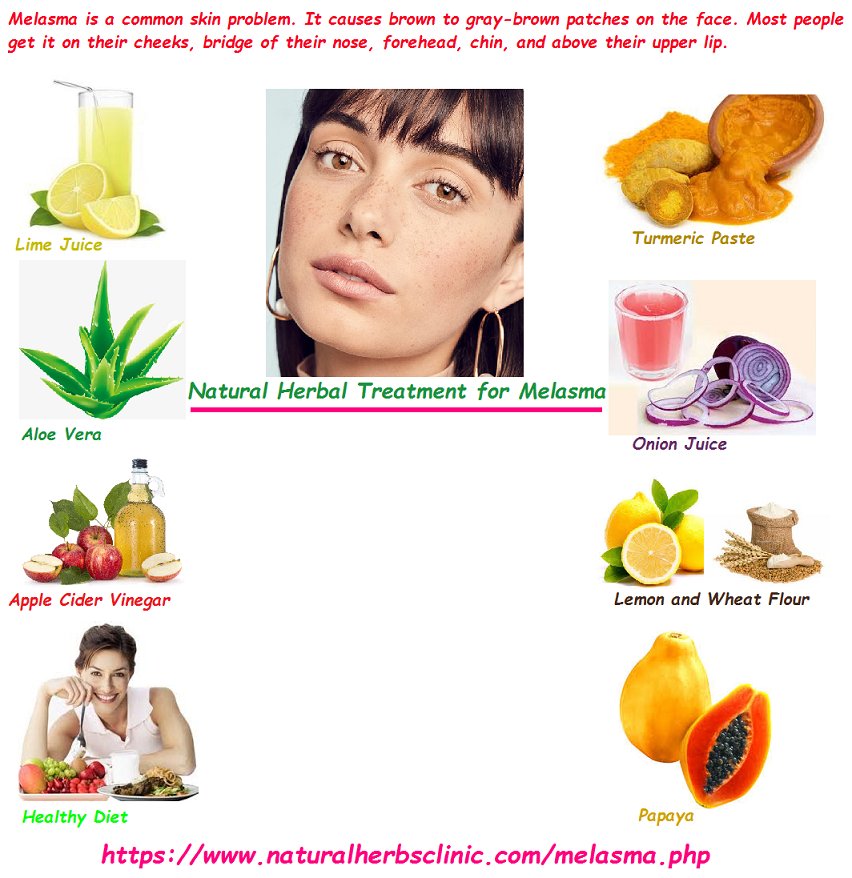 8 Easy Home Herbal Remedies for Melasma Natural Herbs Clinic Blog