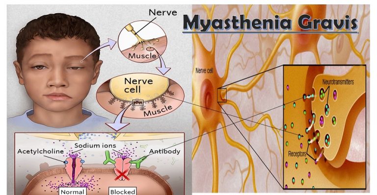 Natural Treatment for Myasthenia Gravis  Natural Herbs Clinic  Blog