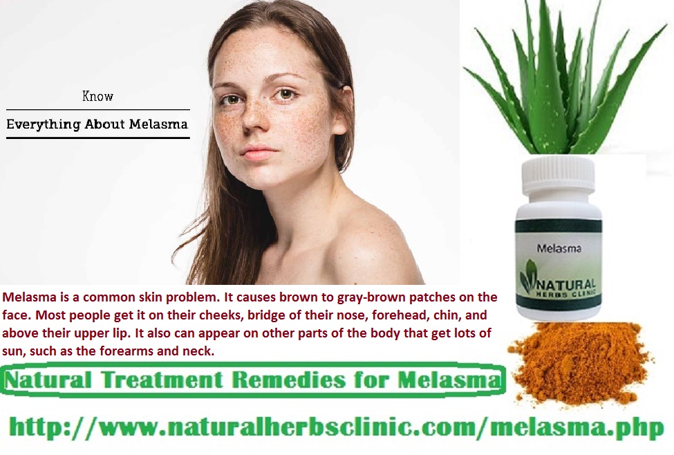 Herbal Remedies for Melasma Symptoms, Causes, Treatment Natural